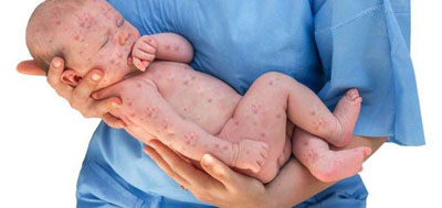  Dinkes Bengkalis Temukan Satu Kasus Kematian Bayi Akibat Rubella